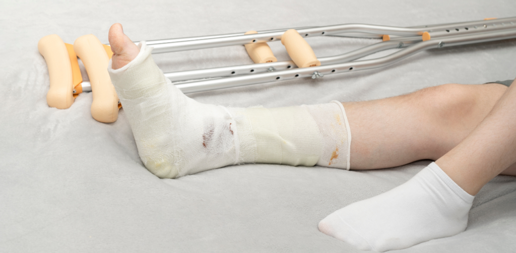 A person's leg wrapped in a cast with visible bandages, resting on a surface beside crutches