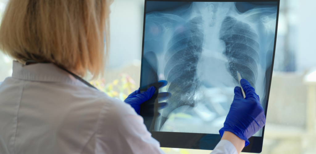 Doctor examining a chest X-ray held up to the light, showing the ribs and lungs in detail