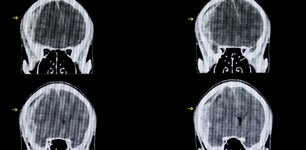 CT brain scans showing potential trauma, marked with yellow arrows